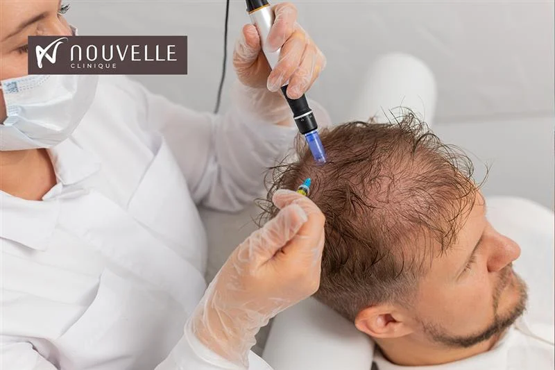 Cost for FUE Sapphire Tirana